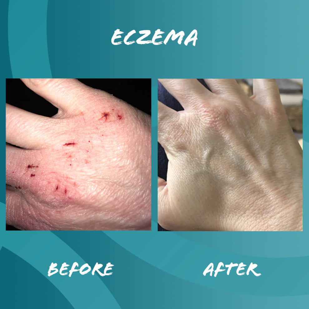 Before and after edible health Collagen Cures Eczema