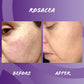 Before and after edible health Collagen Cures Rosacea