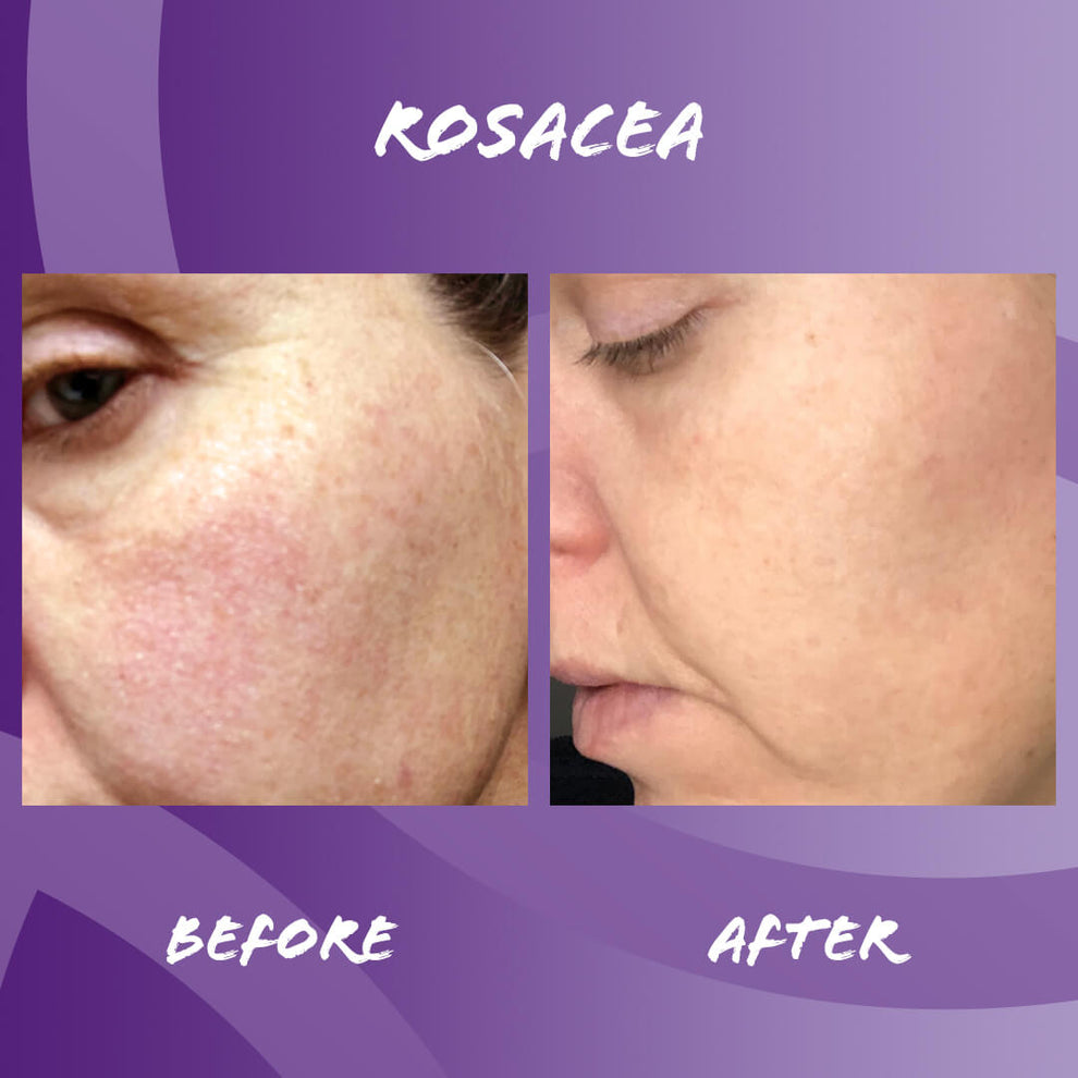 Before and after edible health Collagen Cures Rosacea